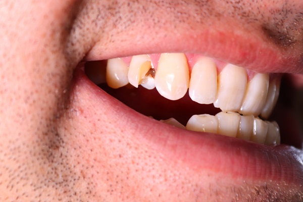 What To Do When You Have A Broken Tooth